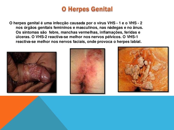 Herpes peniana sintomas fotos 2 Herpes peniana sintomas fotos 49